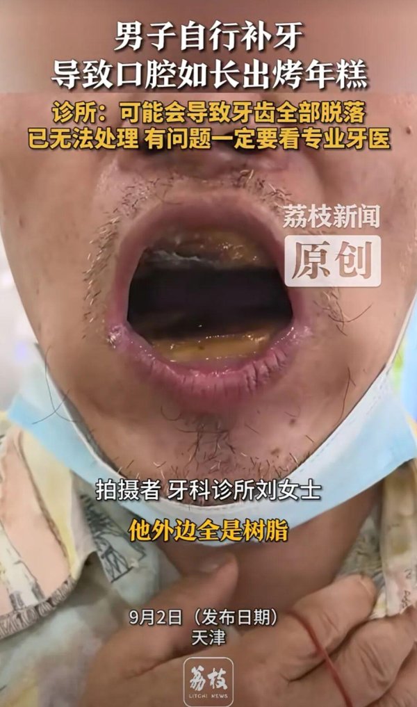 牛顾问策略 男子买5元材料自行补牙，口腔长出“烤年糕”？医生无奈：没人敢拆……